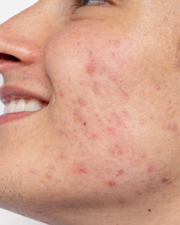 Acné